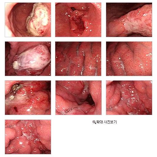 진행성위암 내시경사진