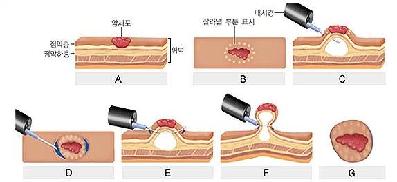 위암의 내시경수술 모식도
