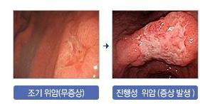 위내시경 검사 시기