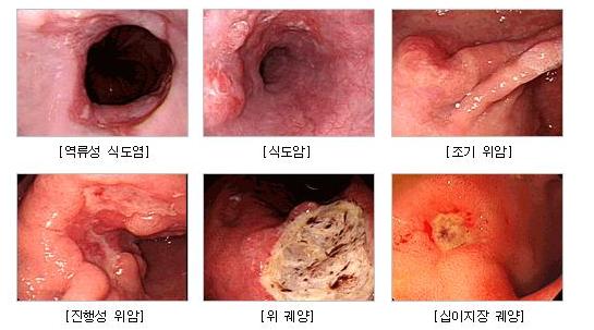 위내시경검사로 진단이 가능한 질병