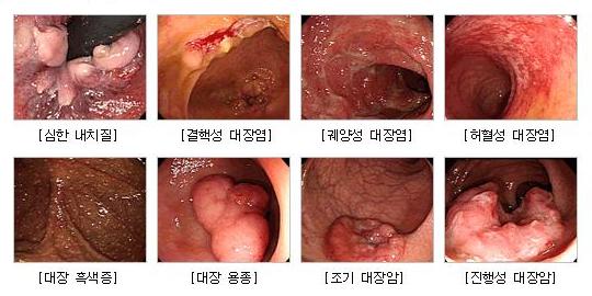 대장내시경으로 진단이 가능한 질병