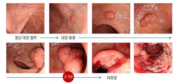 선종-암 연속체